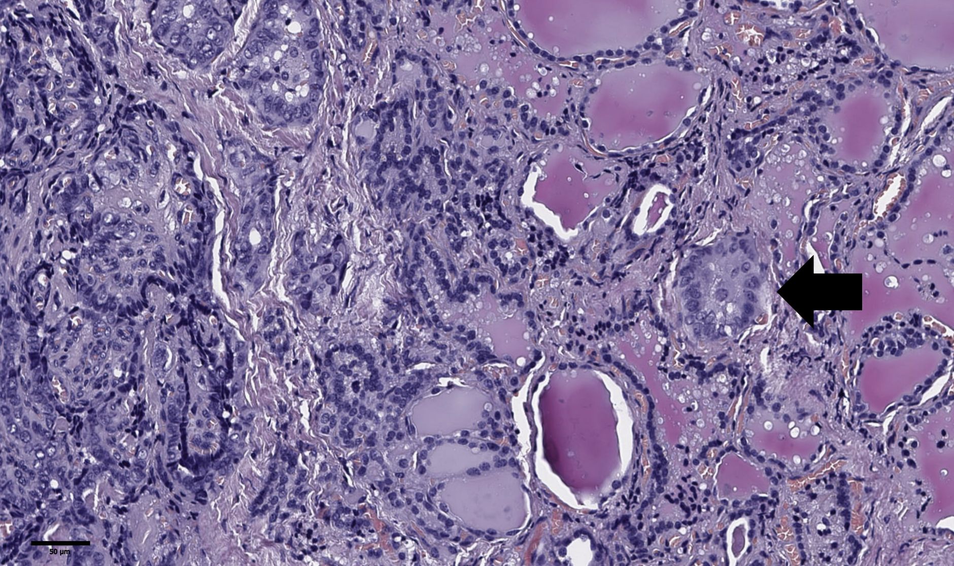 Microscopic image of kidney tissue showing a cluster of dark-stained cells surrounded by lighter pink areas, indicative of a cross-section. A black arrow points to a specific dense region, highlighting an area of interest.