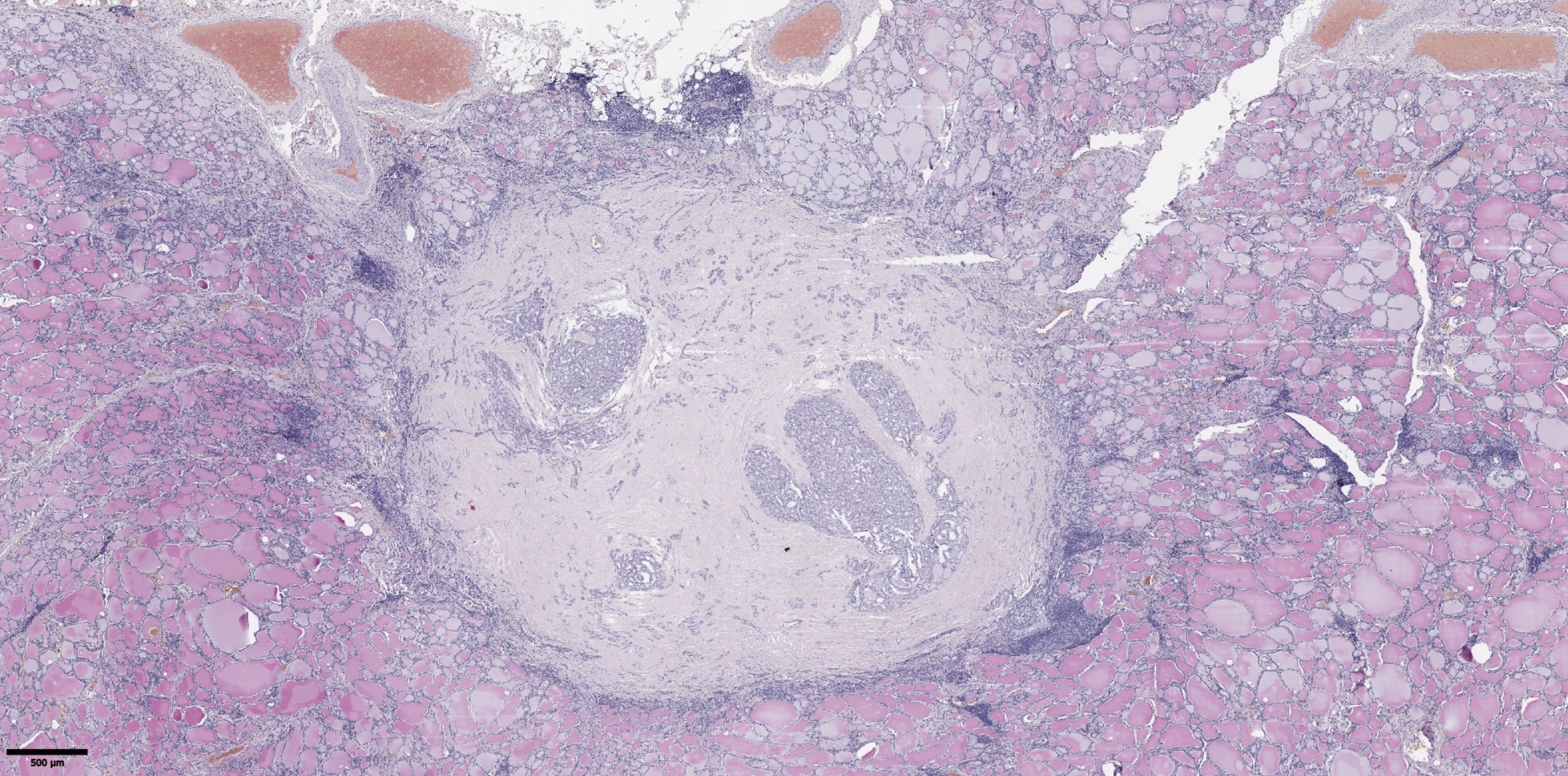 Histological image showing a cross-section of tissue with varying cellular densities. A central pale area is surrounded by darker-stained, microscopic structures. Pink and purple hues dominate, indicating contrasting tissue components.