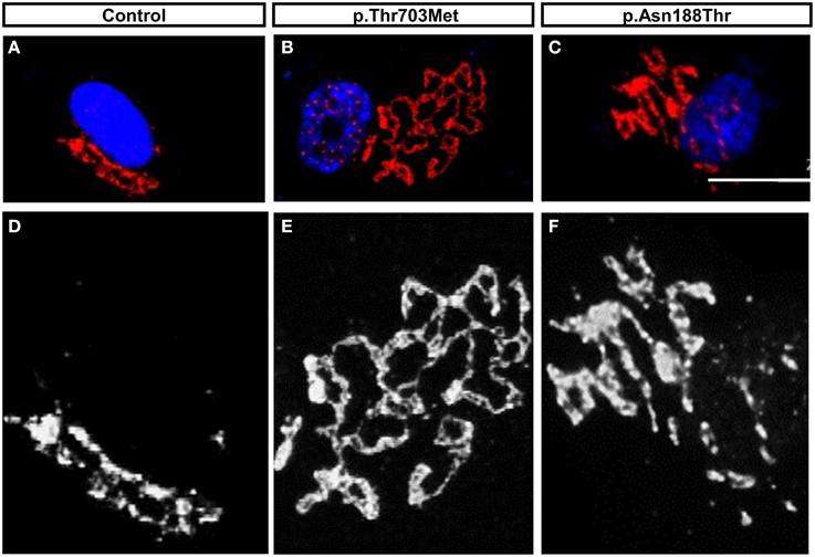 Frontiers | Dominant spinal muscular atrophy is caused by mutations in