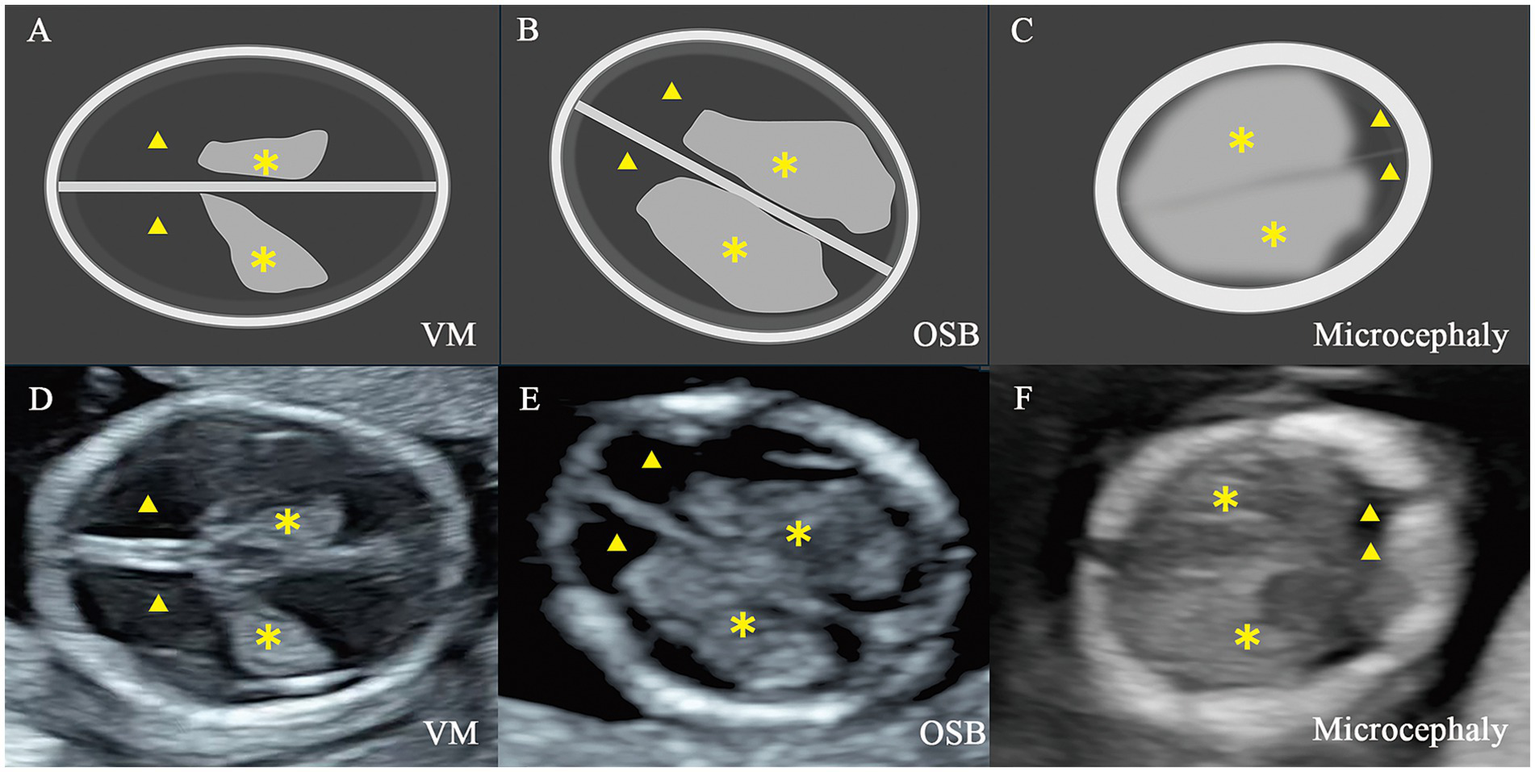 Diagram and ultrasound images illustrating three brain conditions: VM, OSB, and Microcephaly. Panels A, B, and C show graphical representations with triangular and asterisk markers. Panels D, E, and F display corresponding ultrasound images, with the same markers highlighting specific regions.
