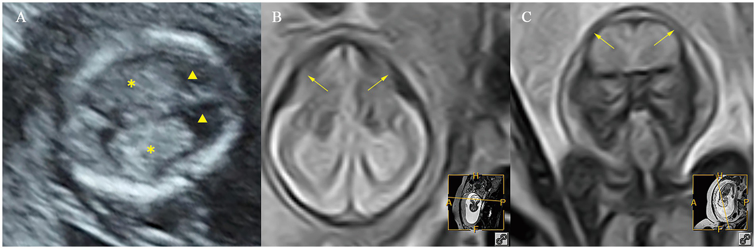 Three medical imaging panels labeled A, B, and C. Panel A shows an ultrasound with two asterisks and two triangular markers highlighting specific regions. Panel B and C are MRI scans with yellow arrows pointing to distinct areas within the brain structure. Each panel is marked with a small locator image indicating the scan slice orientation.