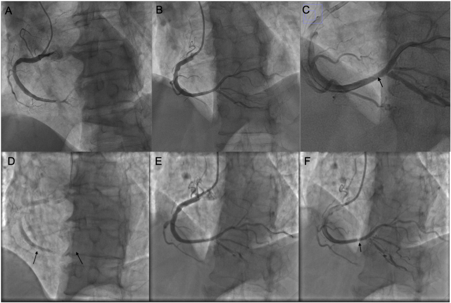 Six grayscale angiographic images labeled A to F show coronary arteries with varying degrees of contrast and visibility. Each panel highlights the arteries, with arrows in images C, D, and F indicating specific points of interest.