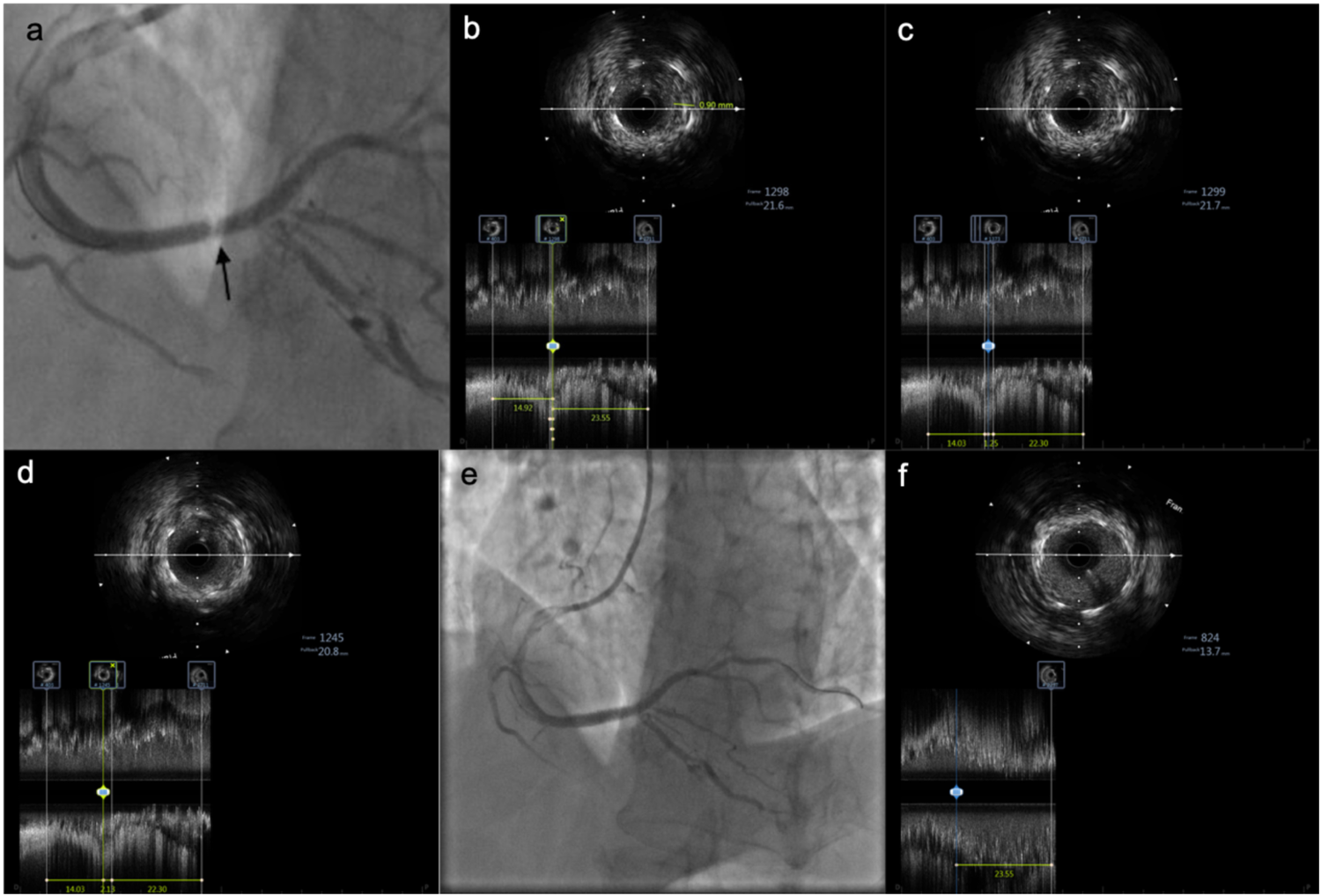 A series of medical images showcasing coronary angiography and intravascular ultrasound (IVUS). Image (a) highlights a coronary artery with an arrow pointing to a narrowing. Images (b), (c), (d), and (f) present IVUS scans depicting cross-sections of the artery with measurements and waveforms. Image (e) is another coronary angiogram displaying the artery's pathway.