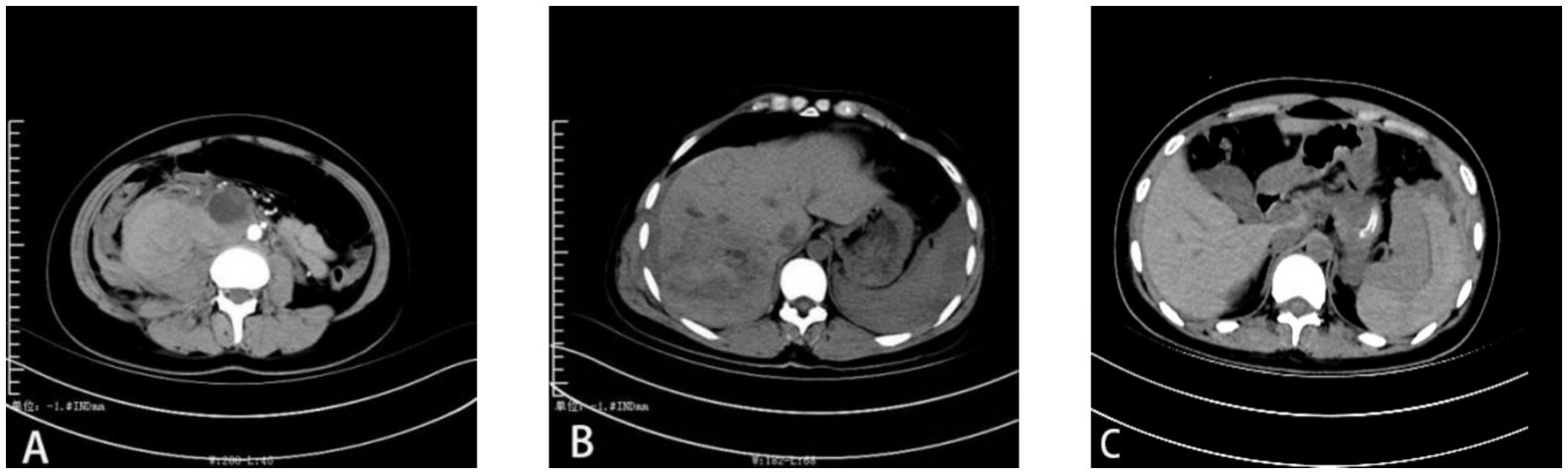 Three CT scan images labeled A, B, and C show axial cross-sections of the abdomen. Image A shows a heterogeneous mass in the left abdomen. Image B depicts a larger mass with greater density variation. Image C illustrates further progression, showing a more defined separation between tissue densities.