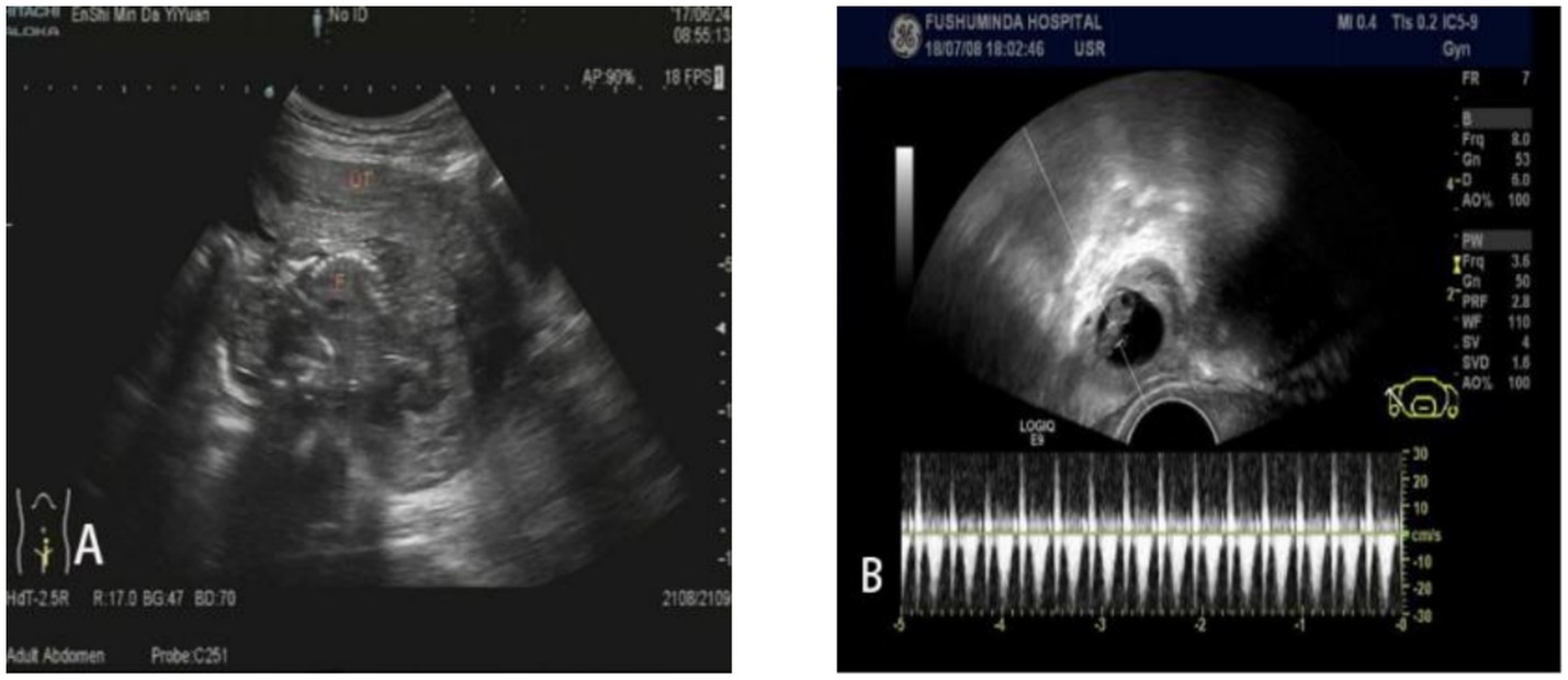 Panel A shows a black and white ultrasound of an abdominal area with labeled sections ‘UT’ and ‘F’. Panel B displays another ultrasound image from Minda Hospital of Hubei Minzu University with a waveform graph below, showing measurements and data in centimeters per second.