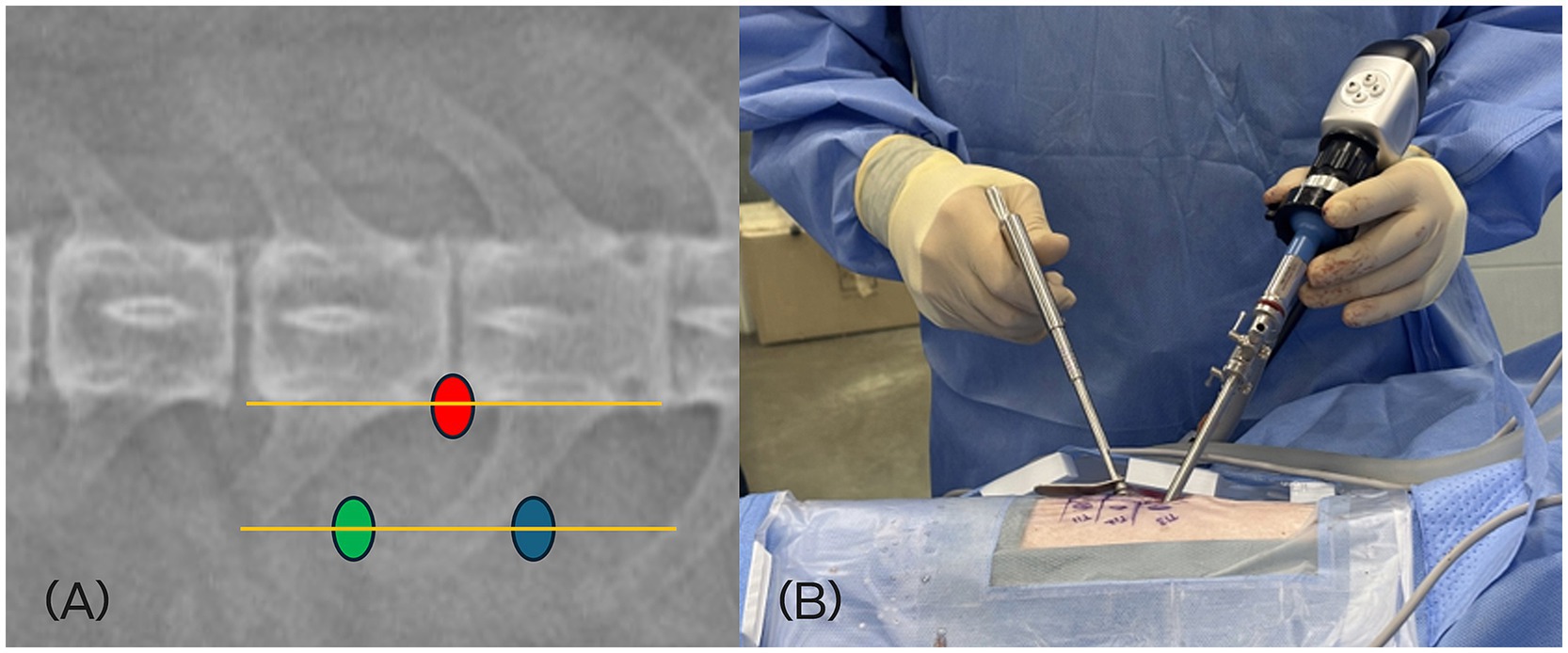 (A) X-ray image of a spine with colored markers and lines indicating specific areas. (B) A person in surgical attire using medical instruments over a patient’s draped area, performing a procedure.