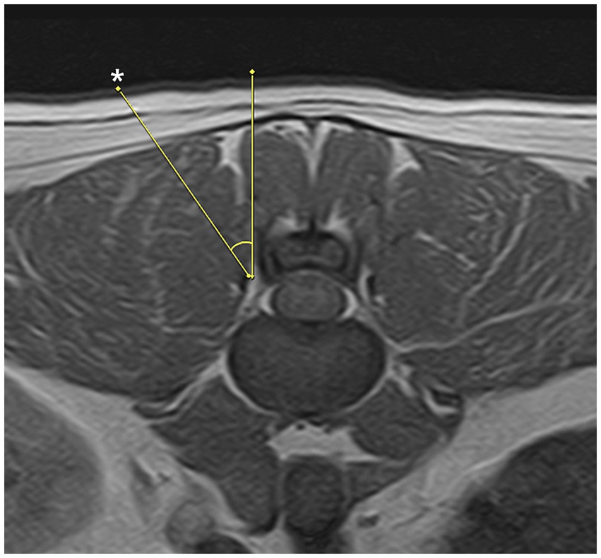 MRI image showing a cross-sectional view of the lumbar spine.