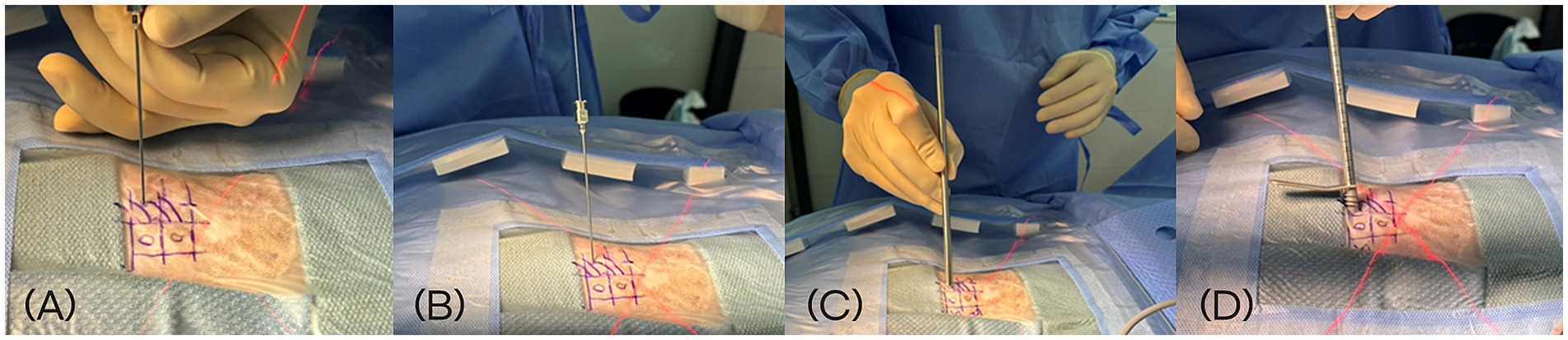 Four-panel sequence illustrating a surgical procedure on a patient’s skin marked with a blue grid. (A) A needle inserted into the skin. (B) Introduction of a K-wire through the spinal needle. (C) Advancement of a 5-mm dilator over the K-wire. (D) Placement of the working portal cannula through the dilator.