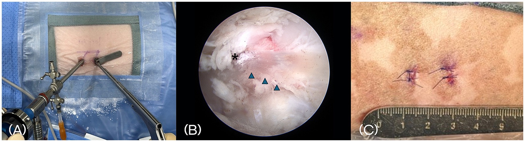 (A) Surgical setup showing instruments inserted into a patient’s spine for endoscopic spine surgery. (B) Endoscopic view of the vertebra, displaying internal structures. (C) Post-surgical image of small suture wounds on the skin, with a ruler for scale.