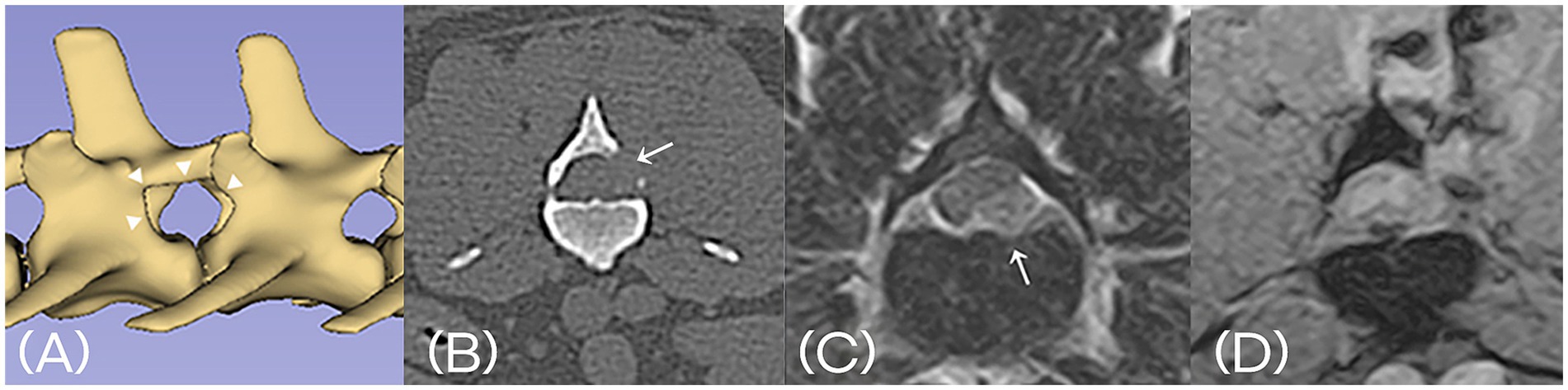 (A) 3D rendering of vertebrae shows structural details with arrows indicating focal points. (B) Cross-sectional CT image highlights vertebral lamina with arrow showing a specific area. (C) MRI scan displays a detailed spinal section with an arrow indicating a region of interest. (D) Another MRI view provides additional perspective on spinal anatomy.