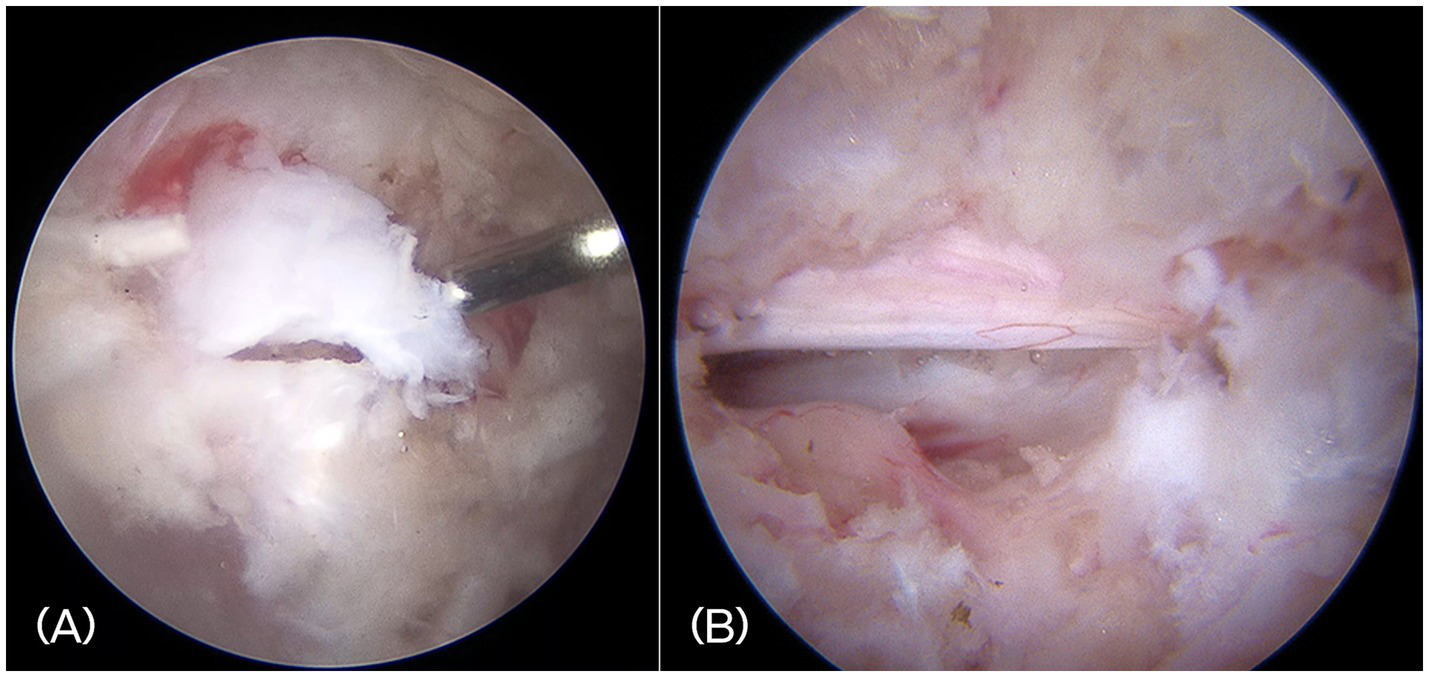 Endoscopic images of a surgical procedure. Panel A shows the extruded disc materials. Panel B displays a close-up of the spinal cord and exiting nerve root.