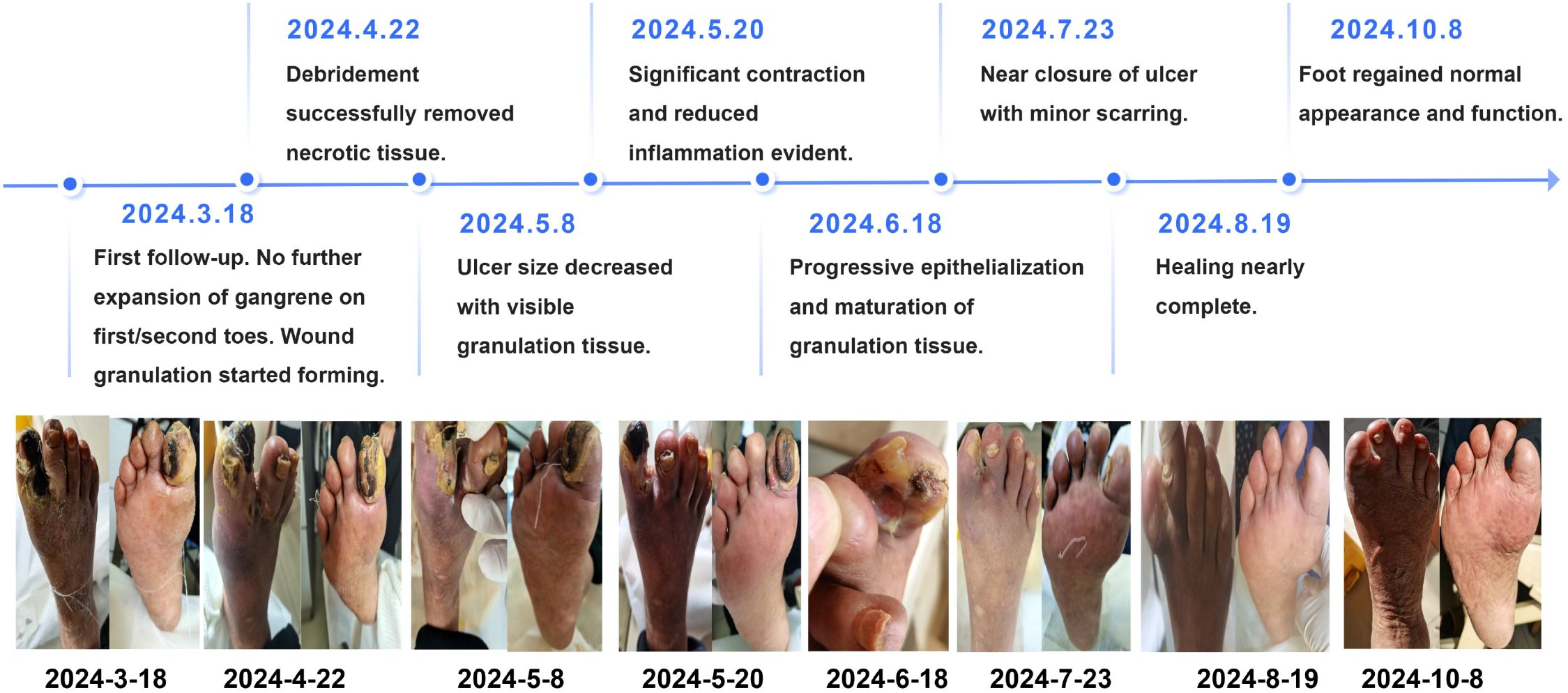 Timeline graphic of a foot's healing process from March 18, 2024, to October 8, 2024. Each date is paired with images and descriptions, showing the gradual healing of gangrene and ulcers. Progression includes debridement, inflammation reduction, granulation, epithelialization, and near-complete healing, concluding with restored appearance and function.
