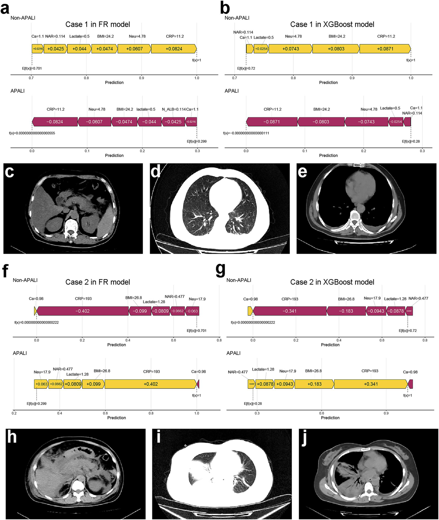 The image contains multiple panels comparing predictions from FR and XGBoost models for two cases, shown with SHAP value plots. Panels a and b display data for Case 1, while panels f and g show data for Case 2. The SHAP plots feature variables such as Car, Lactate, BMI, and CRP, highlighting feature contributions to APALI and non-APALI predictions. Panels c, d, e, h, i, and j display corresponding CT scans for each case, showcasing different cross-sectional views of the thoracic and abdominal regions. The image conveys a study of model predictions against medical imaging data.