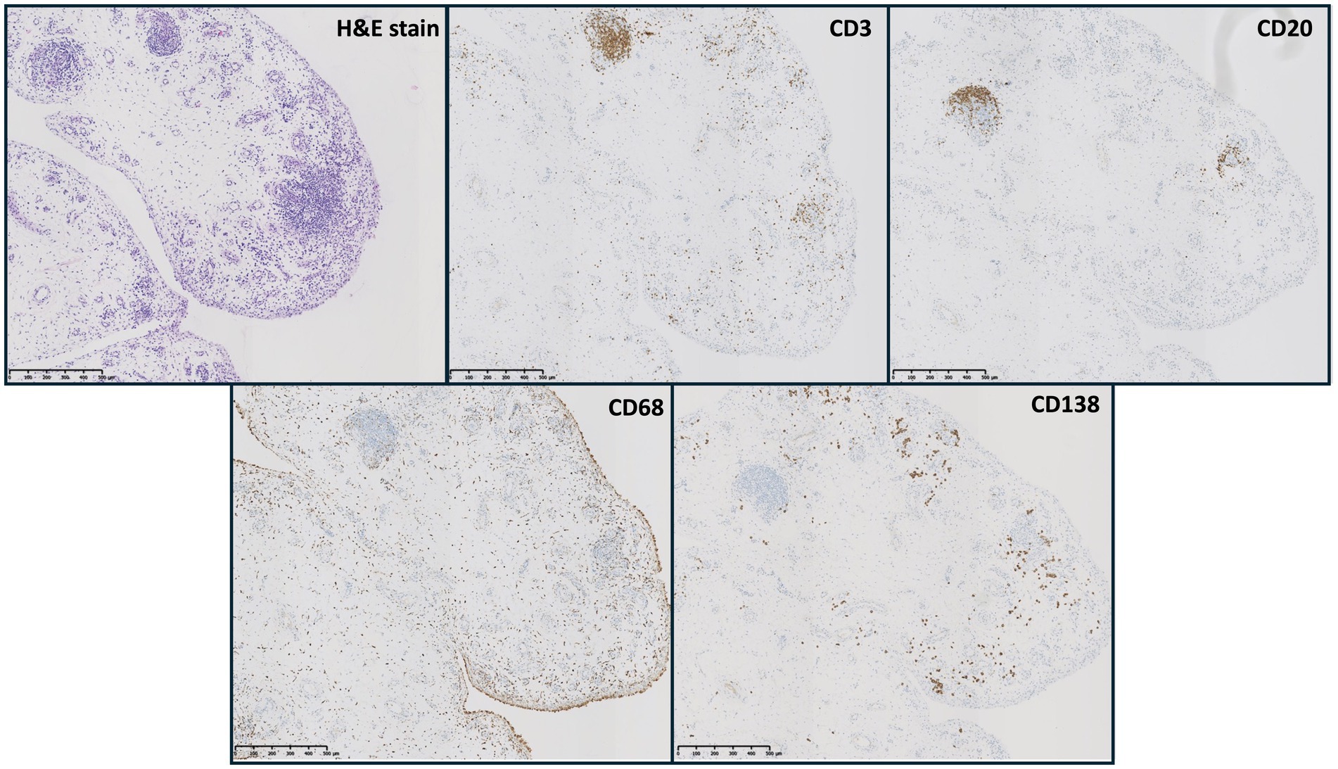 Microscopic images show tissue sections stained with H&E, CD3, CD20, CD68, and CD138. The H&E stain reveals detailed cellular structures with purple hues, while the immunohistochemical stains (CD3, CD20, CD68, CD138) highlight specific markers with brown coloration, indicating the presence of different cell types. Each panel includes a scale bar for measurements.