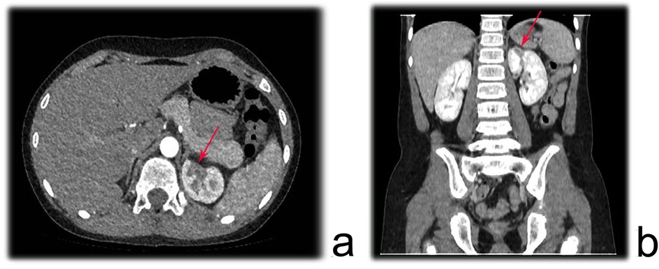 CT scan images showing the abdomen. Image a is an axial view with a red arrow pointing to an area of interest near the kidney. Image b is a coronal view with an arrow indicating a similar area on the kidney.