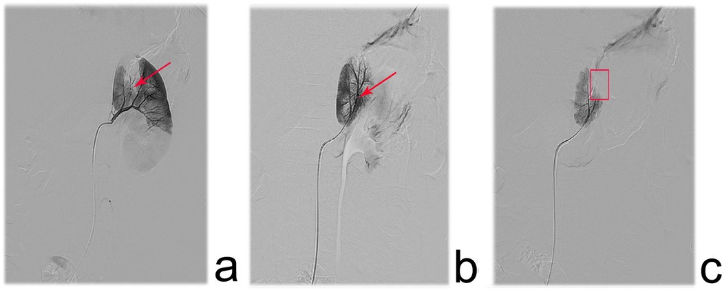 (a) initial diagnosis of a stenotic interlobar artery (red arrow) with distal hypoperfusion; (b) microcatheter advancement to the stenosis (red arrow), confirming the obstructive lesion; (c) final angiogram confirming successful vessel occlusion (highlighted region).