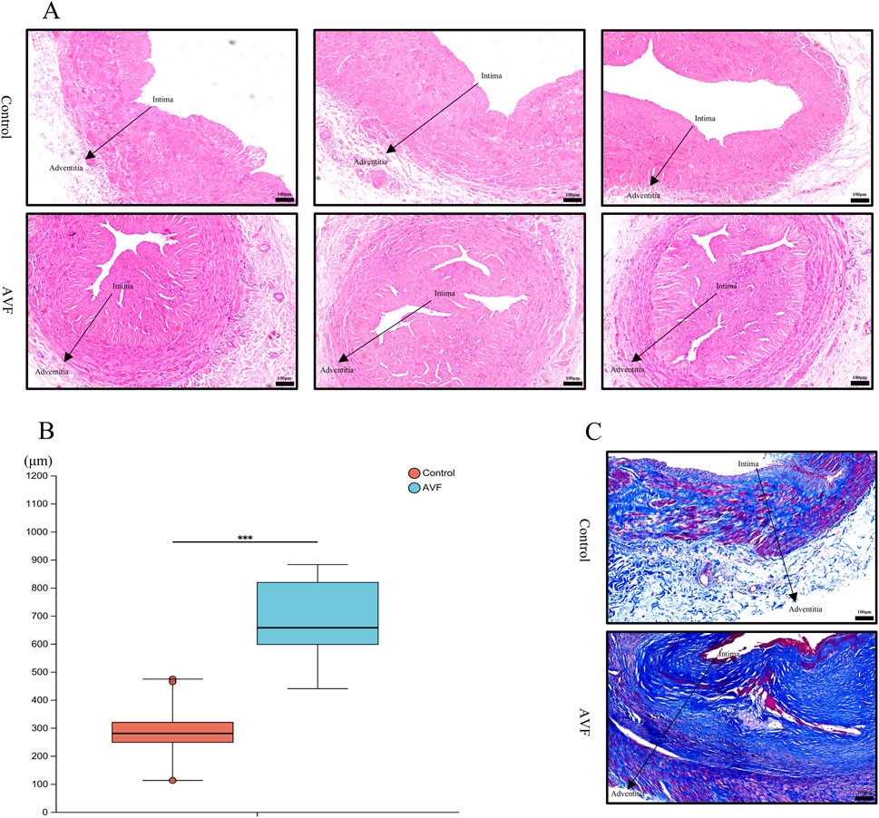 Panel A shows histological sections of blood vessels from control and AVF groups, highlighting the intima and adventitia layers. Panel B is a box plot comparing the thickness of these layers, showing significant differences between control and AVF groups. Panel C displays stained sections, emphasizing structural differences in the intima and adventitia between control and AVF groups.
