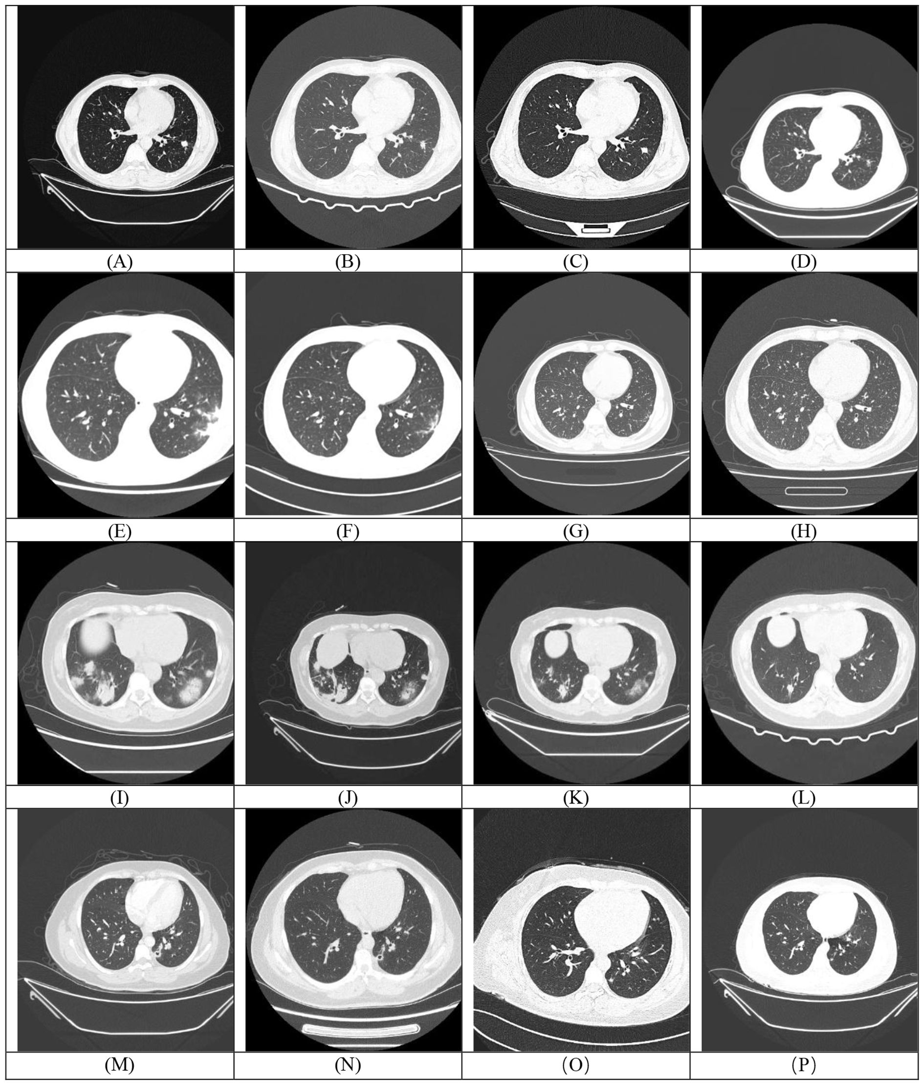 Sixteen chest CT scan images are arranged in a grid with labels A to P. Each image shows cross-sectional views of lungs with various patterns of opacity, indicating different conditions or abnormalities.