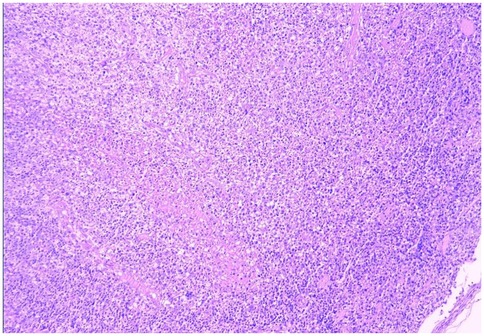 Microscopic view of tissue stained with hematoxylin and eosin, showing densely packed cells with varying sizes and shapes. The image appears purple-pink due to the staining, highlighting the cellular structure and morphology.