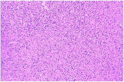 Microscopic view of tissue showing densely packed cells stained purple, with small, dark nuclei visible throughout. The background appears pink, indicating typical histological staining.