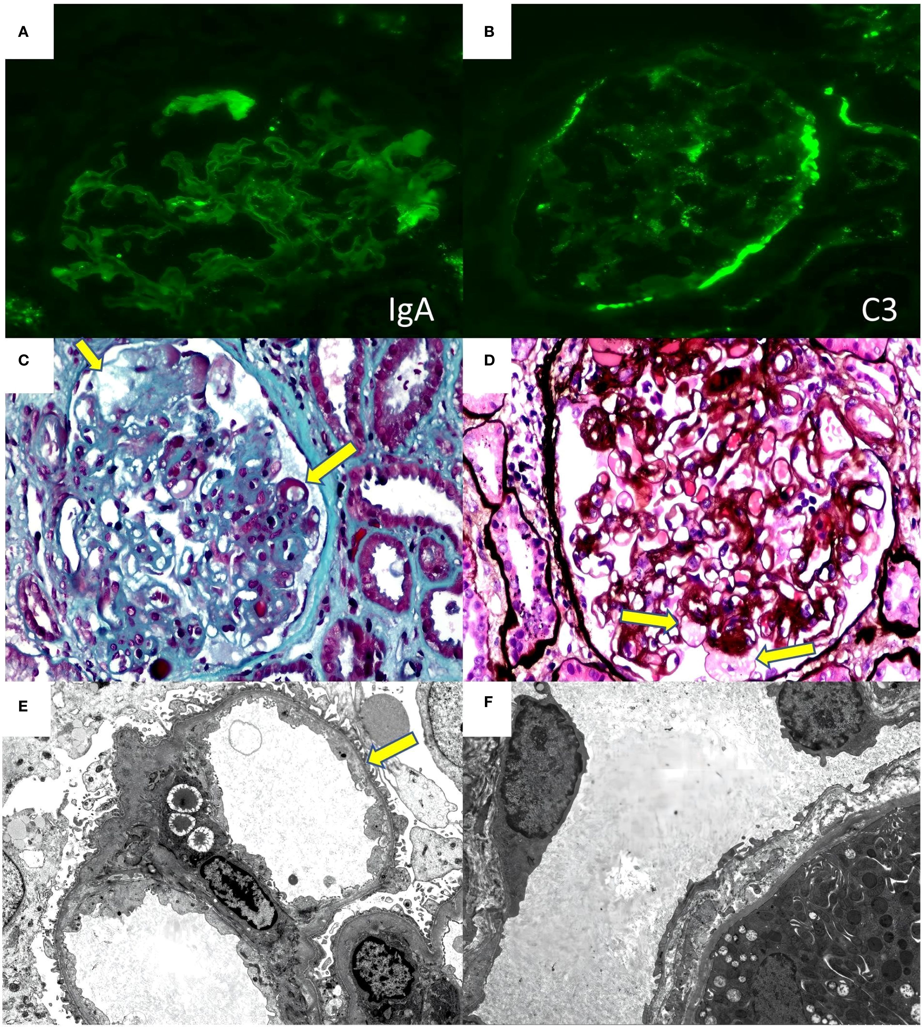 Panel A shows an immunofluorescence micrograph of IgA deposition in renal tissue. Panel B presents an immunofluorescence micrograph of C3 deposition in renal tissue. Panel C is a light micrograph with Masson staining, highlighting glomerular mesangiolysis and subendothelial space widening. Panel D is a light micrograph with PASM+HE staining, highlighting aneurysmal dilatation of glomerular capillaries. Panel E is an electron micrograph, in which subendothelial space widening of glomerular capillaries is observed. Panel F is another electron micrograph, highlighting the diagnostically insignificant stratification of the glomerular basement membrane.