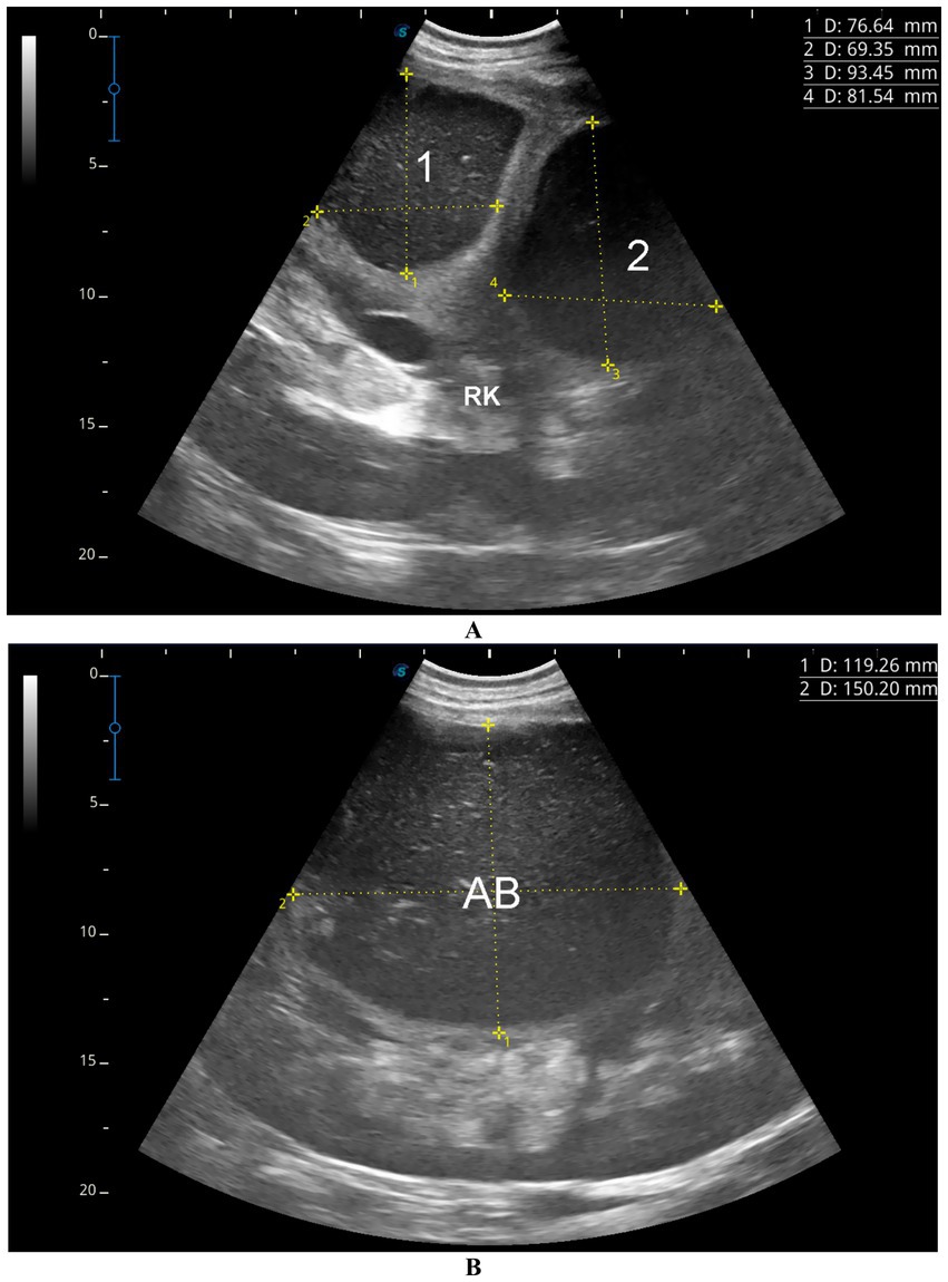 Ultrasound images displaying two different sections. Image A focuses on the right kidney, labeled