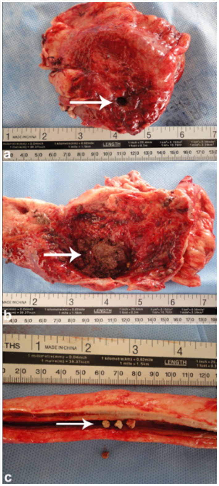 Three medical images of tissue samples with a measuring scale. Image a: Tissue with a dark lesion indicated by an arrow. Image b: Cross-section showing a large mass. Image c: Opened tubular structure with small stones pointed out by an arrow.