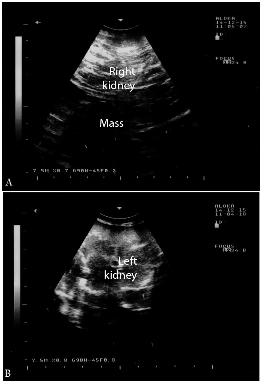 Ultrasound images of kidneys. Panel A shows the right kidney with a labeled mass. Panel B shows the left kidney, labeled clearly. Both images display medical monitor readings.