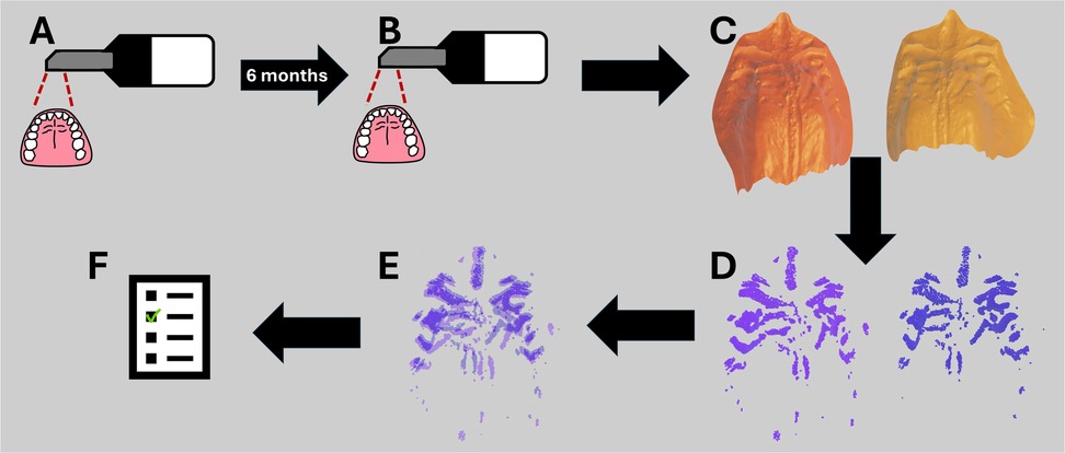 Diagram illustrating dental comparison process. Panel A shows the initial dental scan, panel B shows the follow-up scan after 6 months. Panel C displays the palatal isolation and panel D the rugae extraction. Panel E shows the comparison analysis followed by a scoring shown in panel F.
