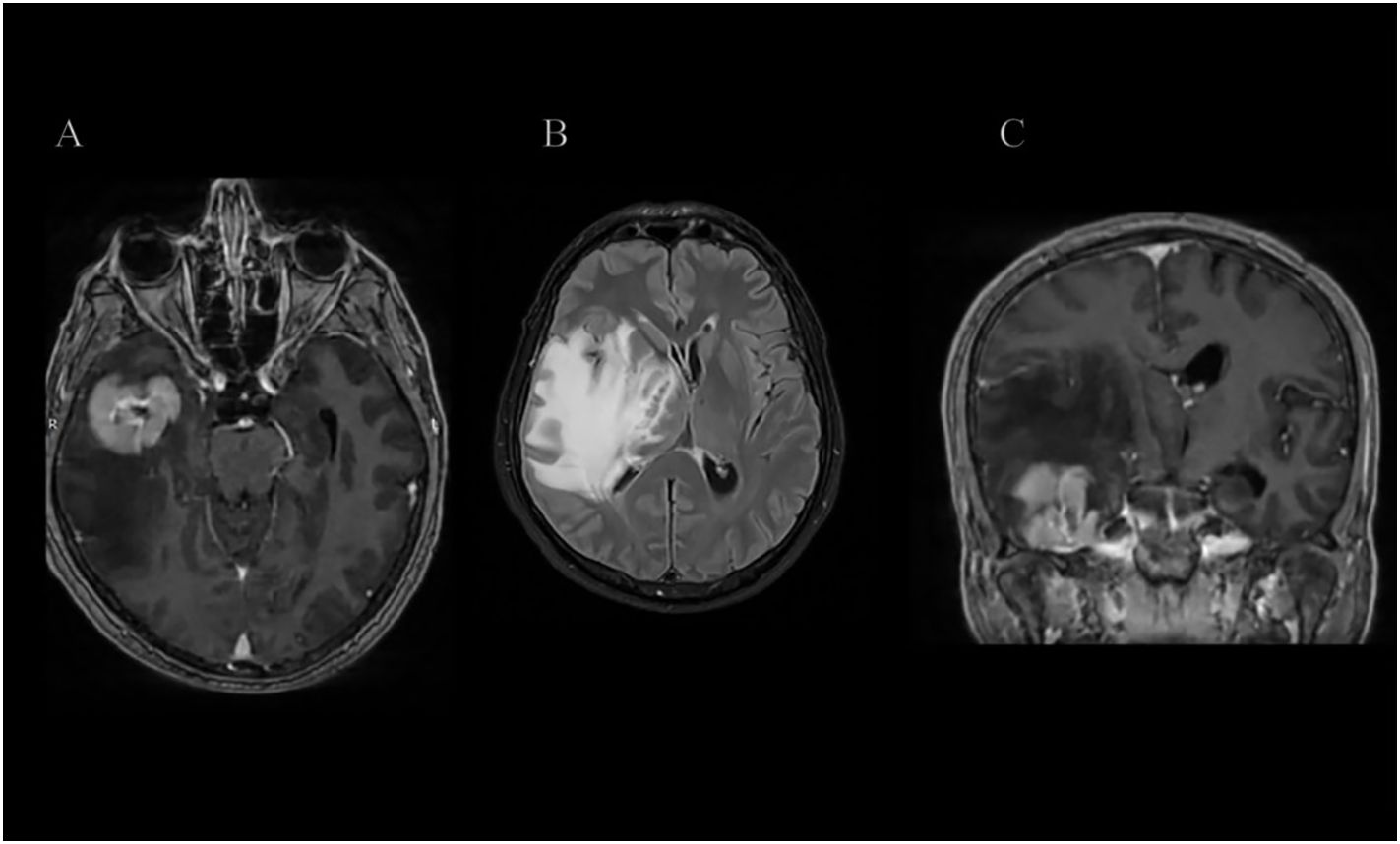 MRI axial and coronal T1 post-contrast and T2 FLAIR sequences showing a homogeneously enhancing intra-axial mass in the right temporal lobe, involving fusiform and inferior temporal gyri, with vasogenic edema causing mass effect, midline shift, and effacement of the right crural cistern.