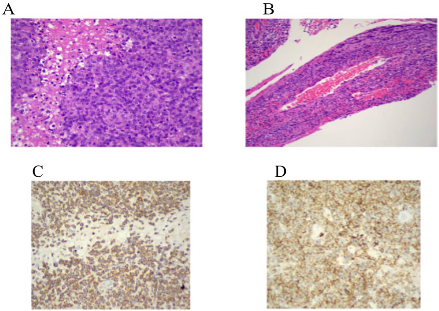 H&E stains show dense atypical lymphoid infiltrates with necrosis and angiocentric distribution. Immunohistochemistry reveals strong CD3 and moderate CD2 expression, indicating T-cell lineage.