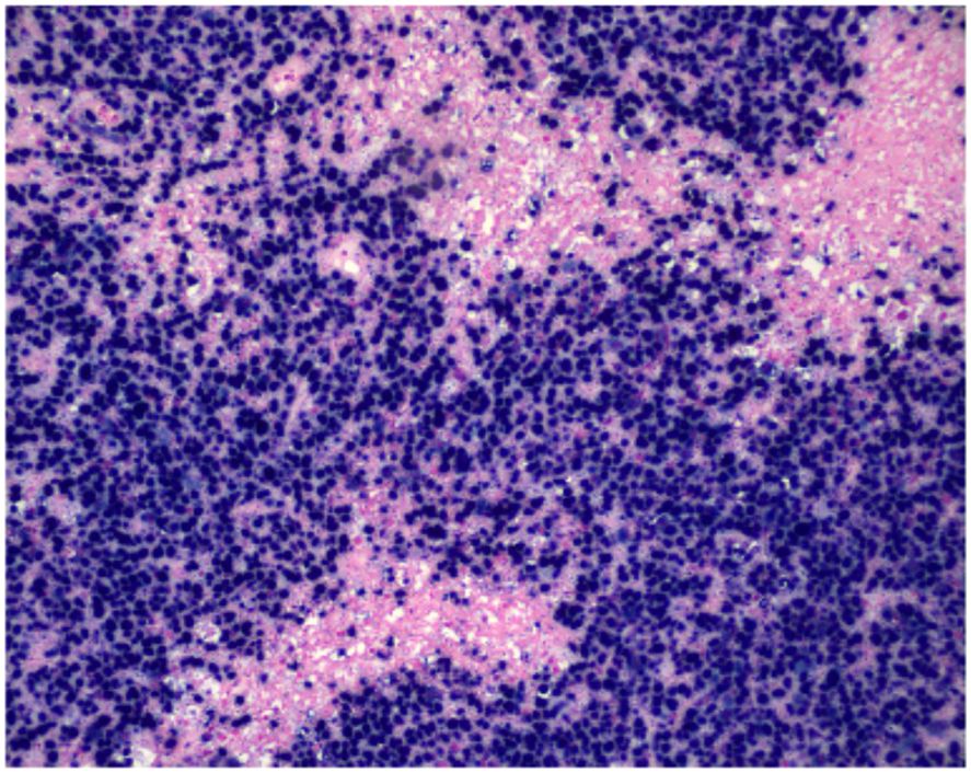 CISH (×200) shows nuclear positivity for EBV-encoded RNA in neoplastic lymphoid cells, indicating EBV involvement.
