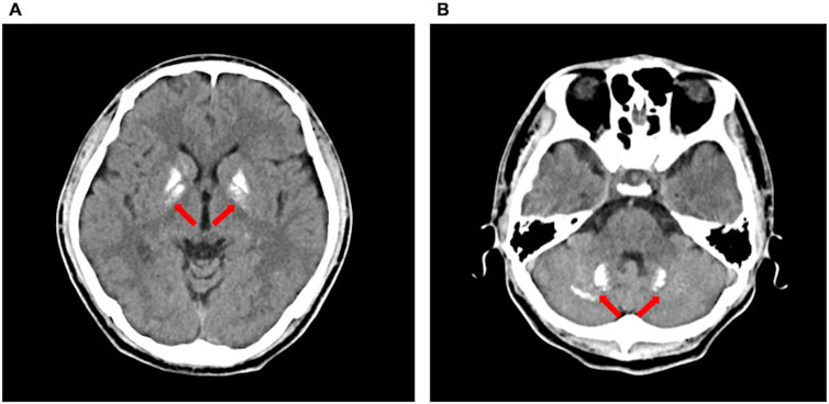 CT scan images in two panels labeled A and B. Panel A shows an axial view of the brain with red arrows indicating symmetrical areas of abnormality. Panel B displays another axial view with red arrows pointing to a different region of interest.