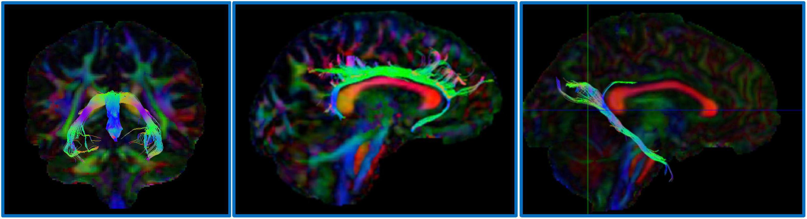 Three-panel brain imaging illustration showing diffusion tensor imaging (DTI) of brain structures. The left panel displays a coronal view, the middle panel shows a sagittal view, and the right panel highlights neural pathways with colorful tracts. Vibrant colors indicate different directions of neural fiber tracts.