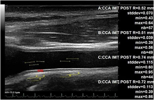 IMT measurement at the middle part of CC and at the bulb area. Echographic image of the common carotid artery up to the bulb area (beginning of bifurcation) at the left, showing automated assessment of the IMT. Each of the four measurements was completed on a total of 44 to 57 adjacent locations along the carotid posterior wall. The IMT changed from 0.51 mm (middle part of CC) up to 0.74 mm (beginning of the bifurcation).
