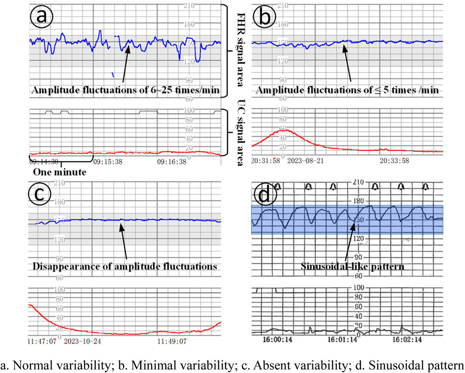 Four graphs display fetal heart rate (FHR) and uterine contraction (UC) patterns. (a) Shows FHR with normal variability and amplitude fluctuations of 6-25 times per minute. (b) Displays minimal variability with amplitude fluctuations of 5 times per minute or less. (c) Illustrates absent variability with disappearance of amplitude fluctuations. (d) Presents a sinusoidal-like pattern in the FHR. Each graph includes time stamps and signal areas for FHR and UC.