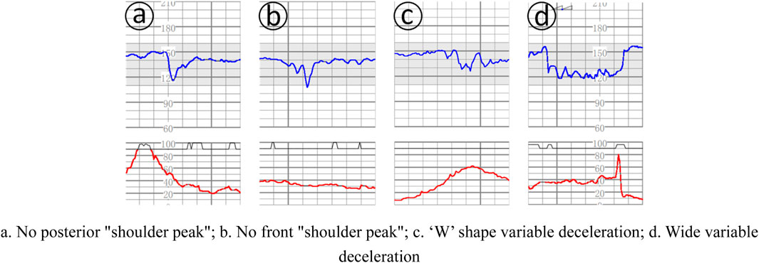 Four cardiotocography tracings labeled a, b, c, and d. Each shows a different pattern of fetal heart rate (blue line) and uterine activity (red line). (a) No posterior