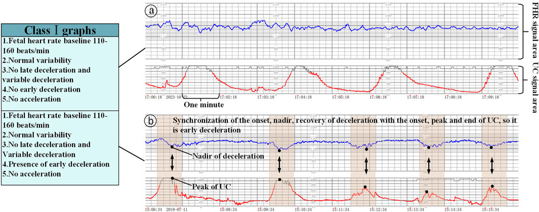 Graphs illustrating fetal heart rate (FHR) and uterine contraction (UC) patterns. Panel (a) shows FHR with no deceleration or acceleration, and UC over time. Panel (b) highlights synchronization of early deceleration in FHR with UC. Text boxes classify both graphs under Class I, listing conditions like fetal heart rate baseline, variability, deceleration, and acceleration presence.