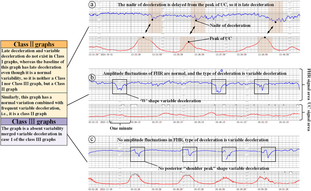 Diagram showing graphs of fetal heart rate (FHR) and uterine contraction (UC) patterns classifying them into Class II and Class III. Graph (a) depicts late deceleration; graph (b) shows W-shaped variable deceleration with normal FHR fluctuations; graph (c) illustrates absence of variability with no posterior shoulder peak. Annotations explain the observations, such as late deceleration and variable deceleration types.