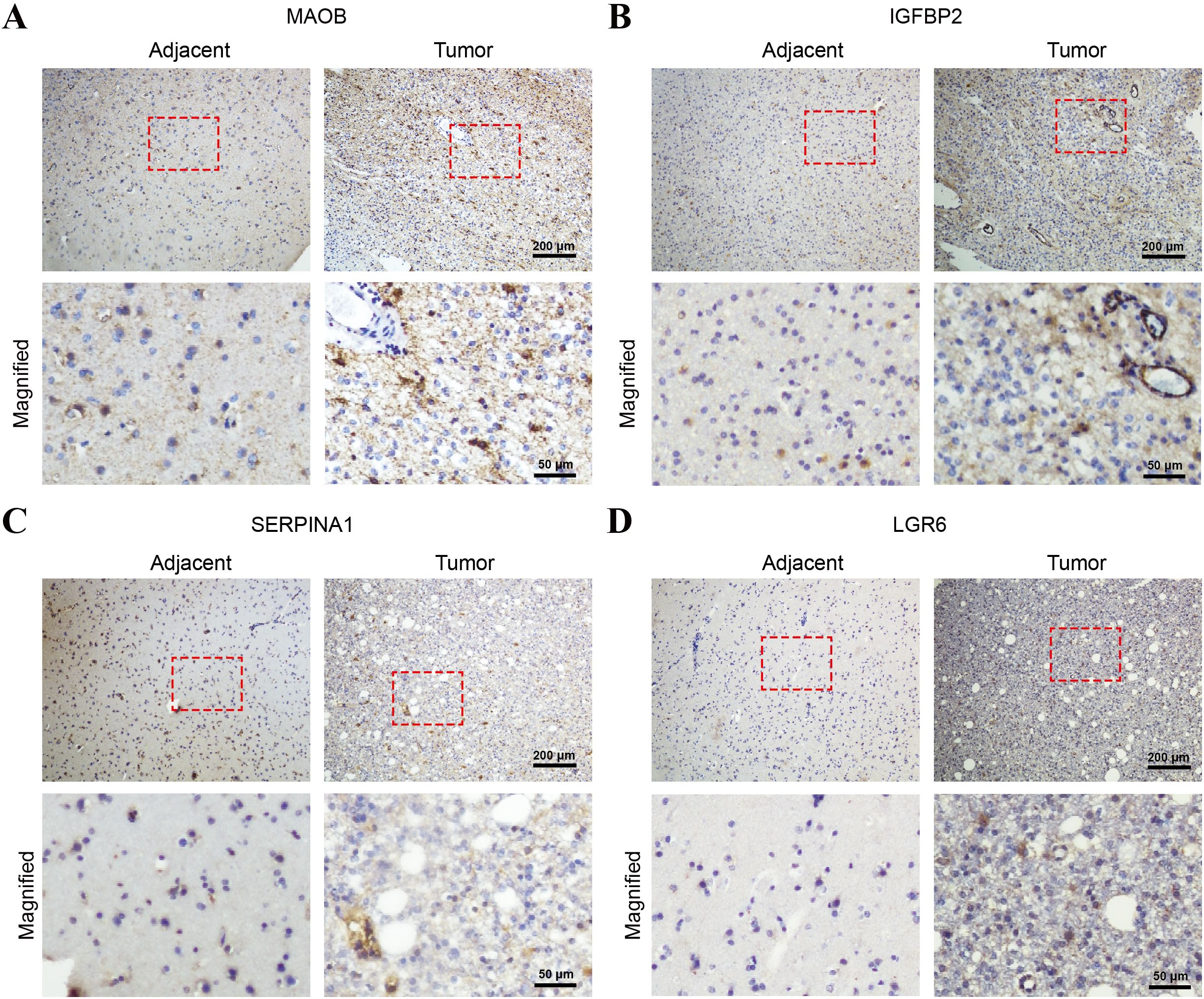Histological images of tissues stained to show four proteins: MAOB, IGFBP2, SERPINA1, and LGR6. Each section displays adjacent and tumor tissues in pairs, with both wider views and magnified sections within red boxes. The magnification showcases cellular details, highlighting staining differences between adjacent and tumor tissues. Scale bars are provided for size reference.