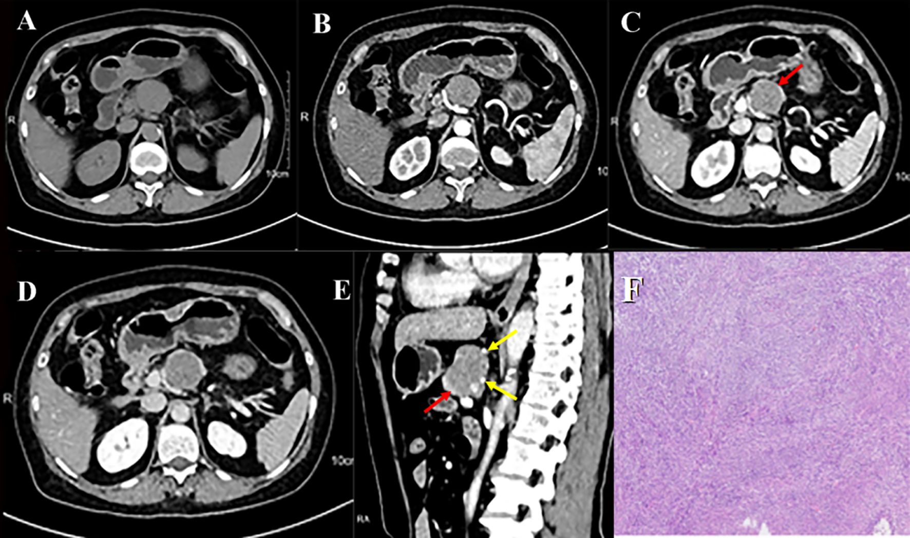 A series of medical images showing CT scans and a histological slide. Images A to D display axial CT scans of the abdomen with varying contrast phases. Image C highlights an area with a red arrow. Image E is a sagittal CT scan with red and yellow arrows indicating specific areas. Image F is a histological slide showing cellular details in purple, suggesting tissue analysis.