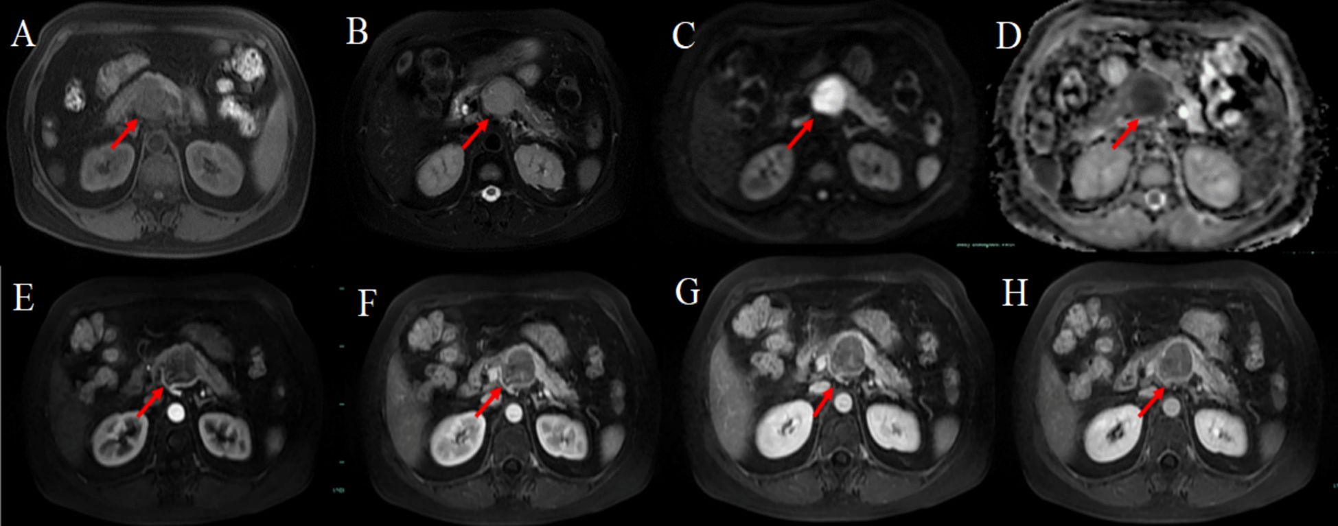 Series of eight axial MRI images labeled A to H showing different phases or contrast levels of the abdomen. Each image highlights a specific area indicated by a red arrow, possibly depicting variation or abnormalities in the same region across different imaging techniques.