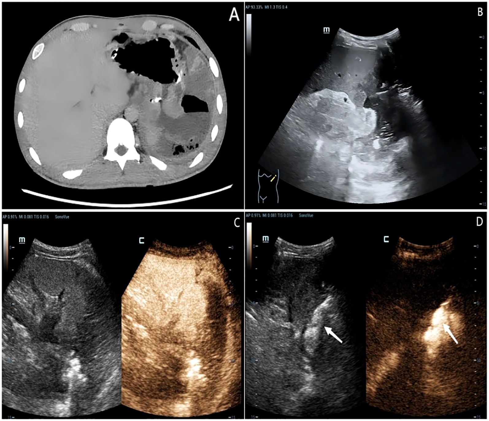 Four medical imaging panels labeled A, B, C, and D. Panel A shows a CT scan with abdominal structures. Panel B presents an ultrasound image of the spleen. Panel C contains dual ultrasound images, one grayscale and one CEUS, with spleen details. Panel D also has dual images with arrows indicating a specific area in both grayscale and CEUS.