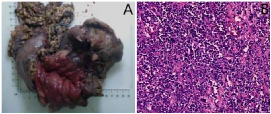 Panel A shows the entire stomach, body and tail of pancreas, and spleen. Panel B displays postoperative pathology(hematoxylin-eosin staining).