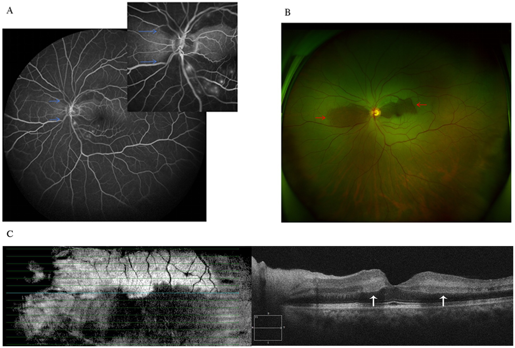 A set of three eye imaging results. Panel A shows a black and white fluorescein angiography image with blue arrows highlighting the vascular structure. Panel B presents a color fundus photograph with red arrows indicating areas of interest in the retina. Panel C comprises an optical coherence tomography scan, showing cross-sectional layers of the retina, with white arrows pointing towards specific areas.