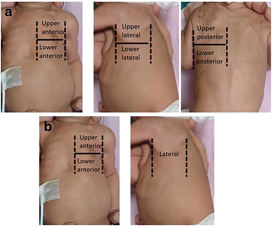 Five images of an infant's torso marked with dashed lines indicating different sections. Top row: labeled as (a), showing \