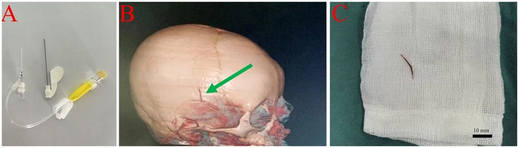 Panel A shows medical instruments, including a needle and a fluid-filled syringe. Panel B depicts a side view of a human skull with a green arrow indicating a specific area. Panel C displays a small, thin object on a piece of gauze, with a scale marker indicating 10 millimeters.