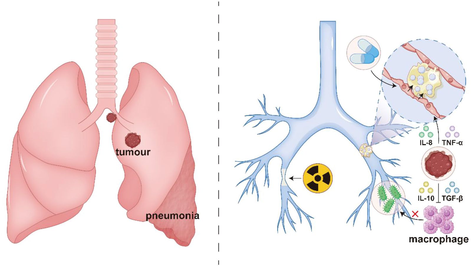 Illustration showing a comparison between healthy lungs affected by a tumor and pneumonia on the left, and an immune response in the bronchioles on the right. The left side features labeled “tumour” and “pneumonia” areas. The right side illustrates inflammation with macrophages and cytokines like IL-8, TNF-α, IL-10, and TGF-β in the bronchioles, along with depictions of a medicine capsule, bacteria, and a macrophage.