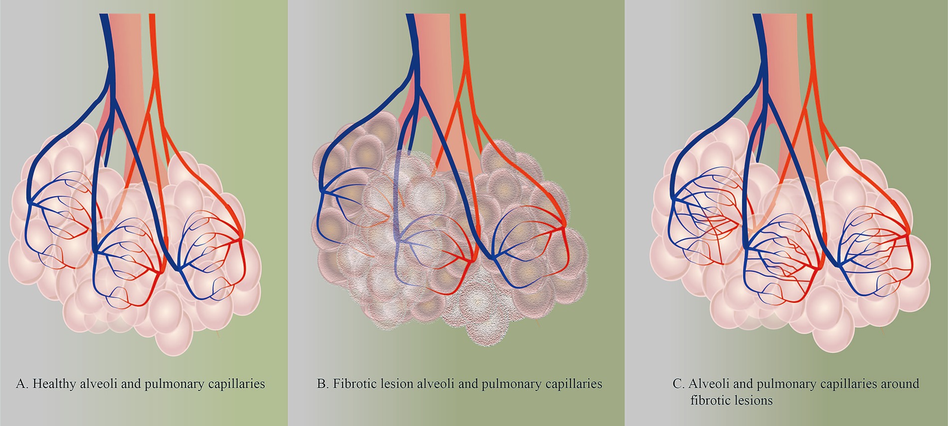 Three-panel illustration of pulmonary fibrotic progression: A: Healthy alveolar structure with intact capillary networks. B: Fibrotic lesions demonstrating significantly reduced capillary density within pathological areas. C: Adjacent healthy lung tissue exhibiting increased capillary density surrounding fibrotic foci.