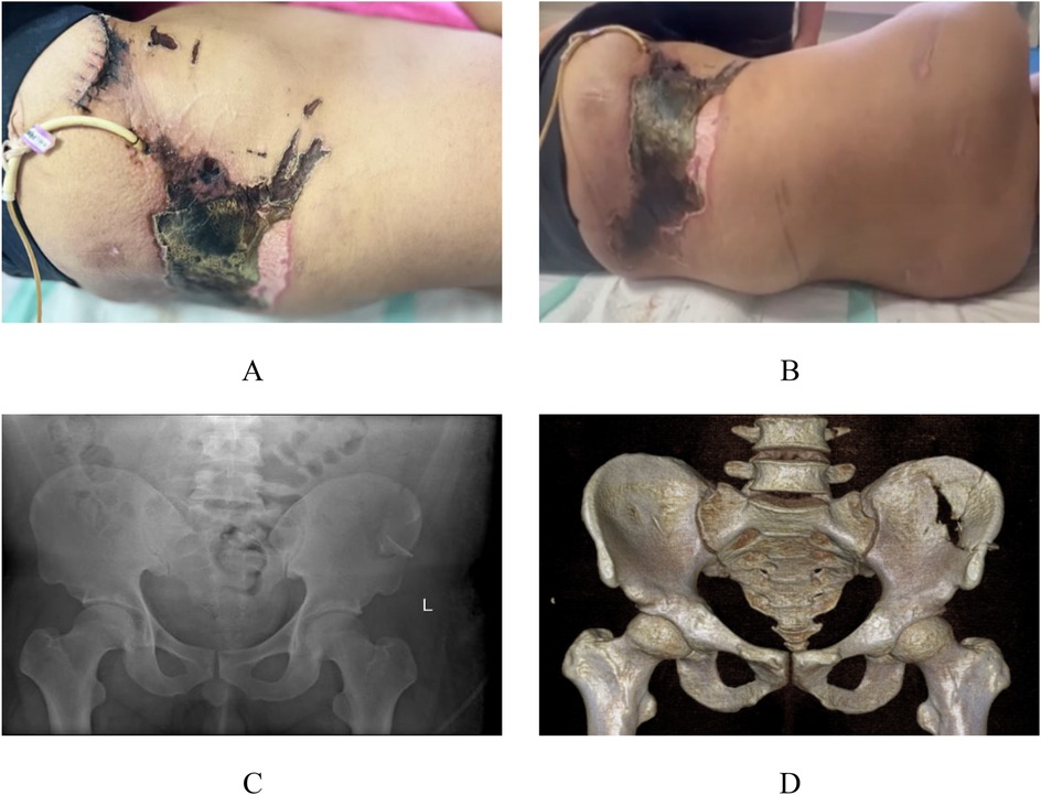 A set of four images: (A) shows a close-up of a severe skin lesion with necrosis on the side of the hip area. (B) displays a wider view of the same injury from a different angle. (C) is an X-ray image of the pelvis showing bone structure. (D) presents a 3D reconstruction of the pelvis, highlighting potential bone abnormalities.